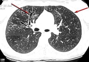 Asthma Imaging and Diagnosis: Practice Essentials, .